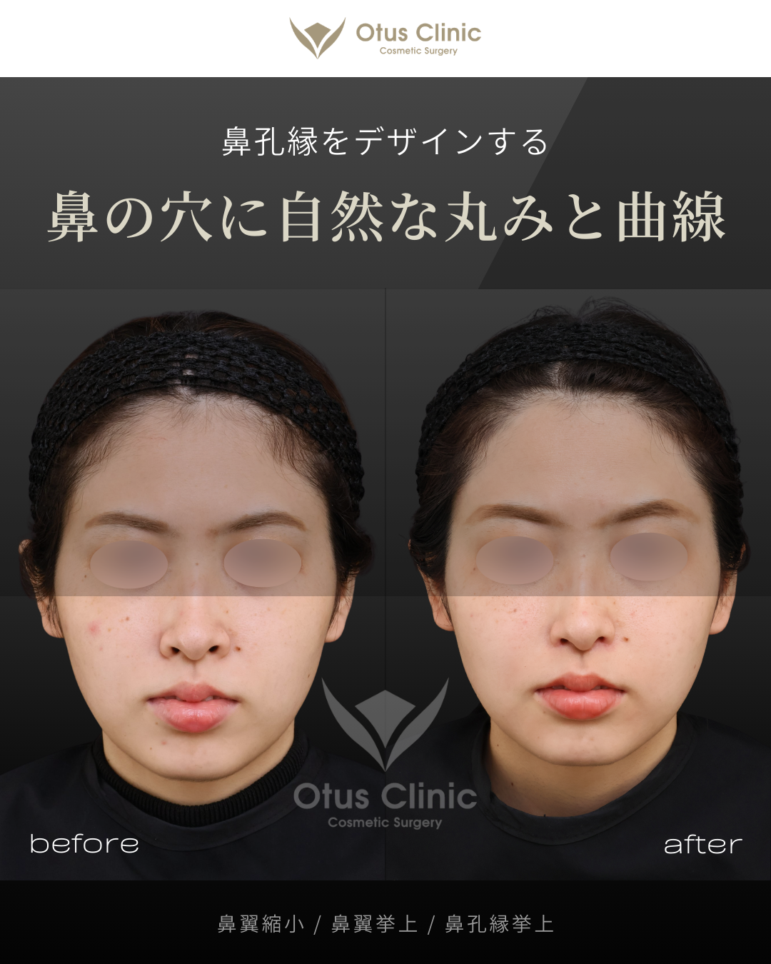 鼻翼縮小・鼻翼挙上・鼻孔縁挙上