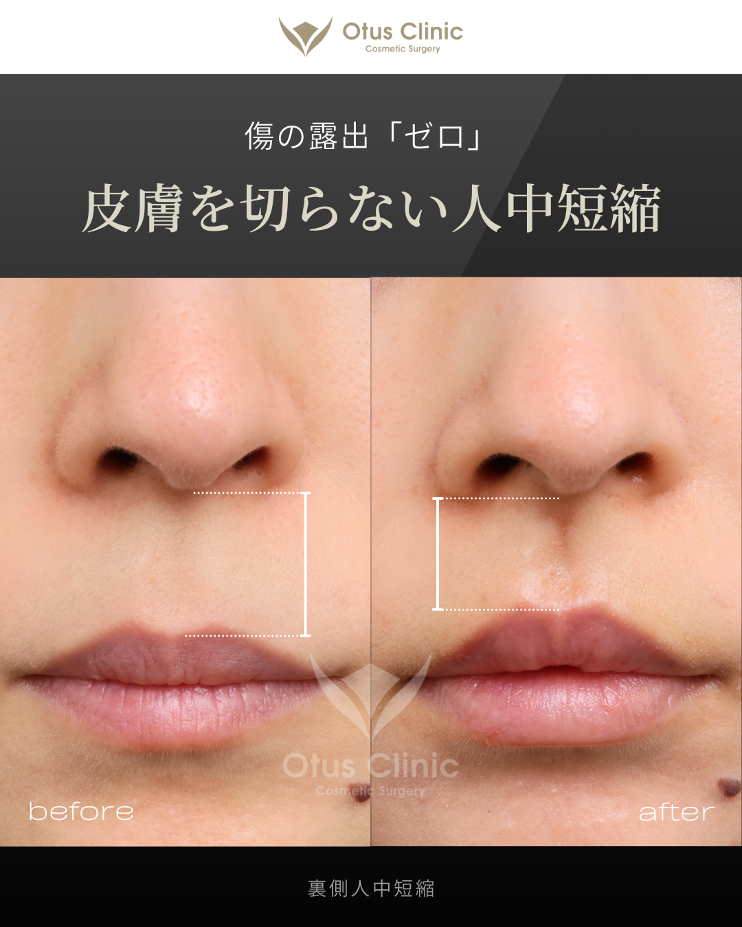 裏側人中短縮（切らない人中短縮）