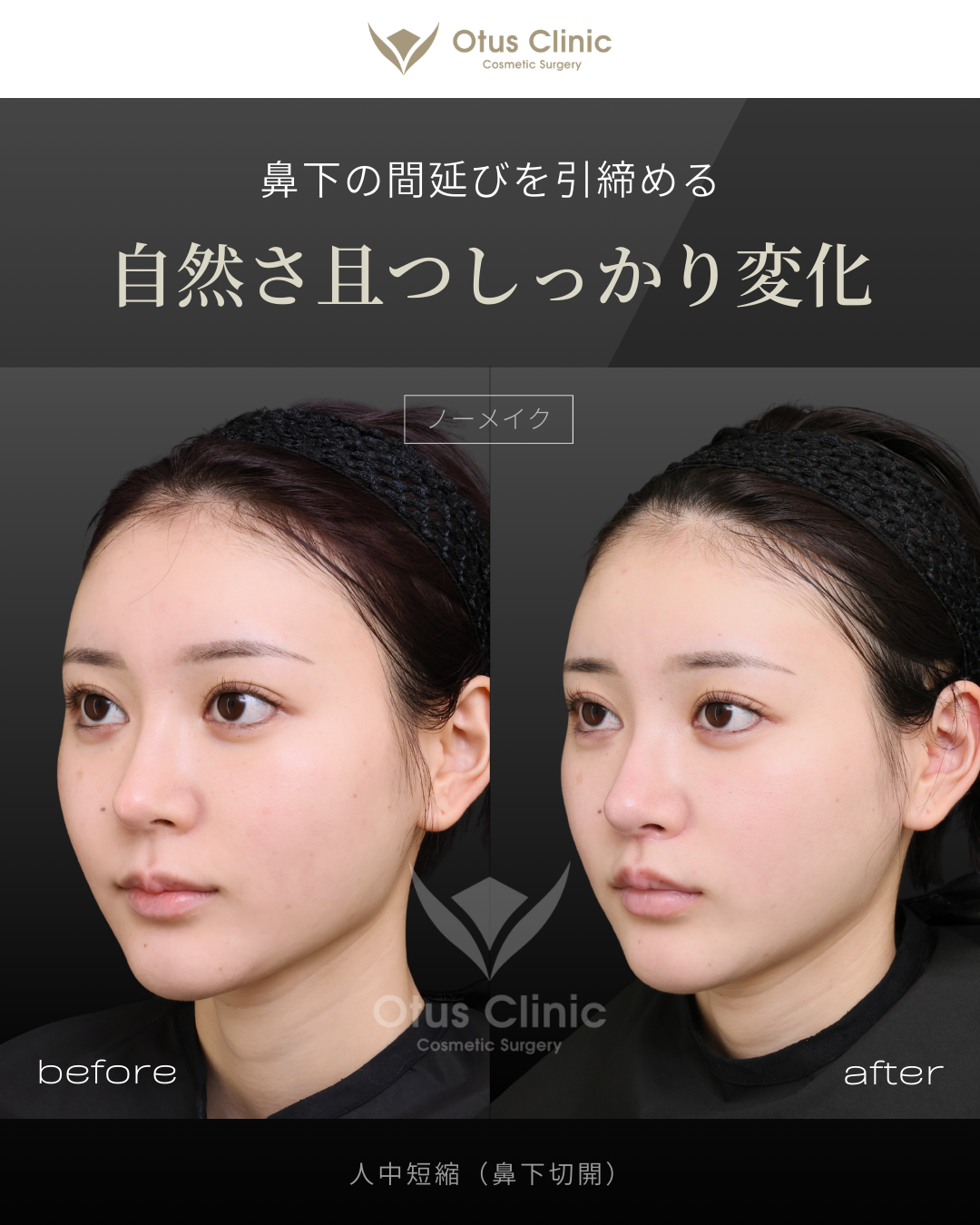 人中短縮(鼻下切開)