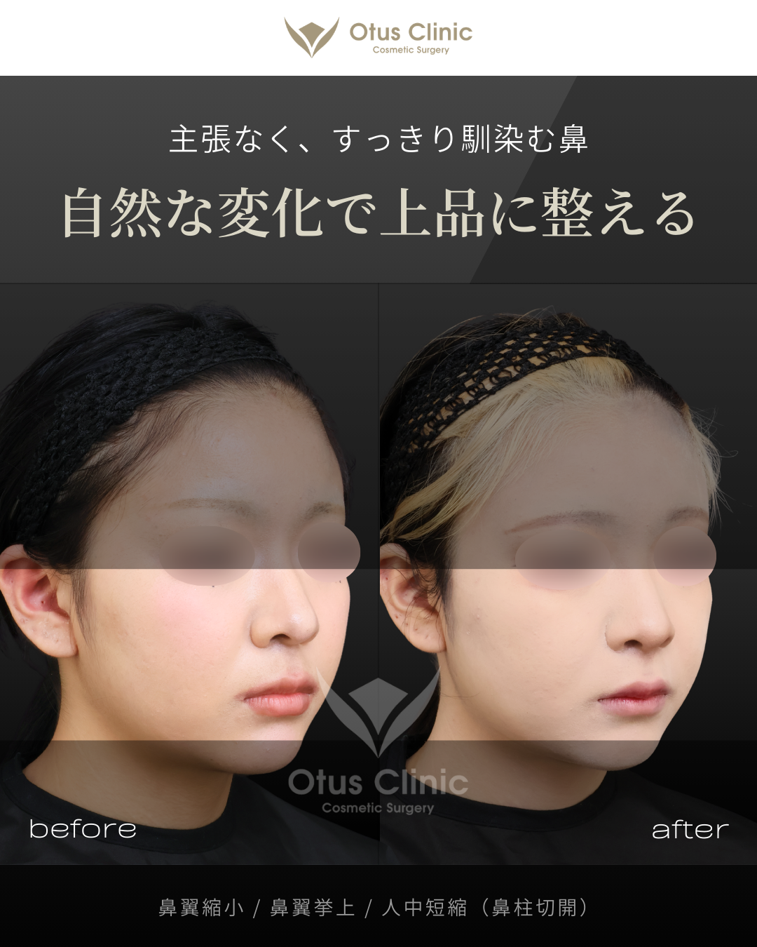 鼻翼縮小・鼻翼挙上・鼻柱切開人中短縮