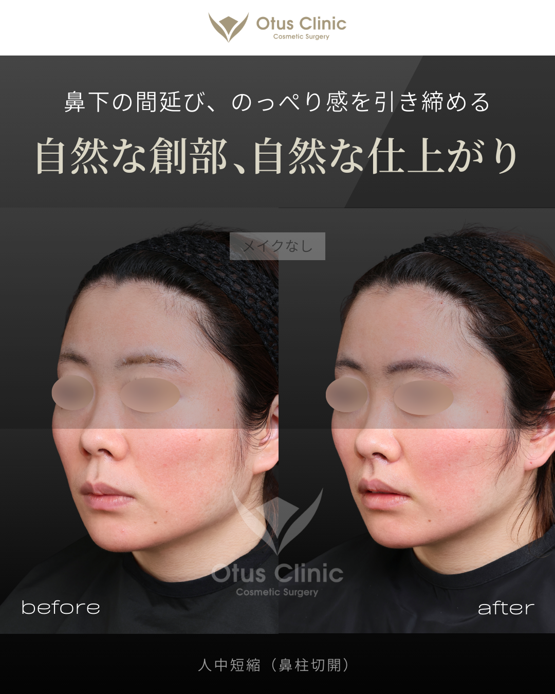 鼻柱切開人中短縮