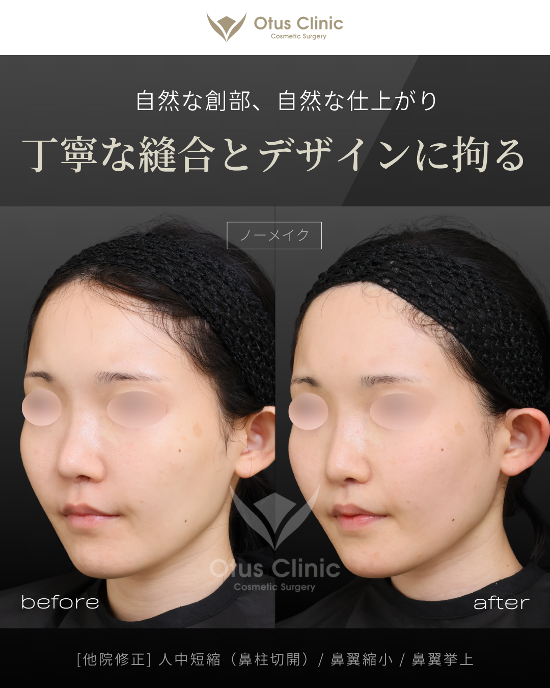 【他院修正】鼻柱切開人中短縮・鼻翼縮小・鼻翼挙上