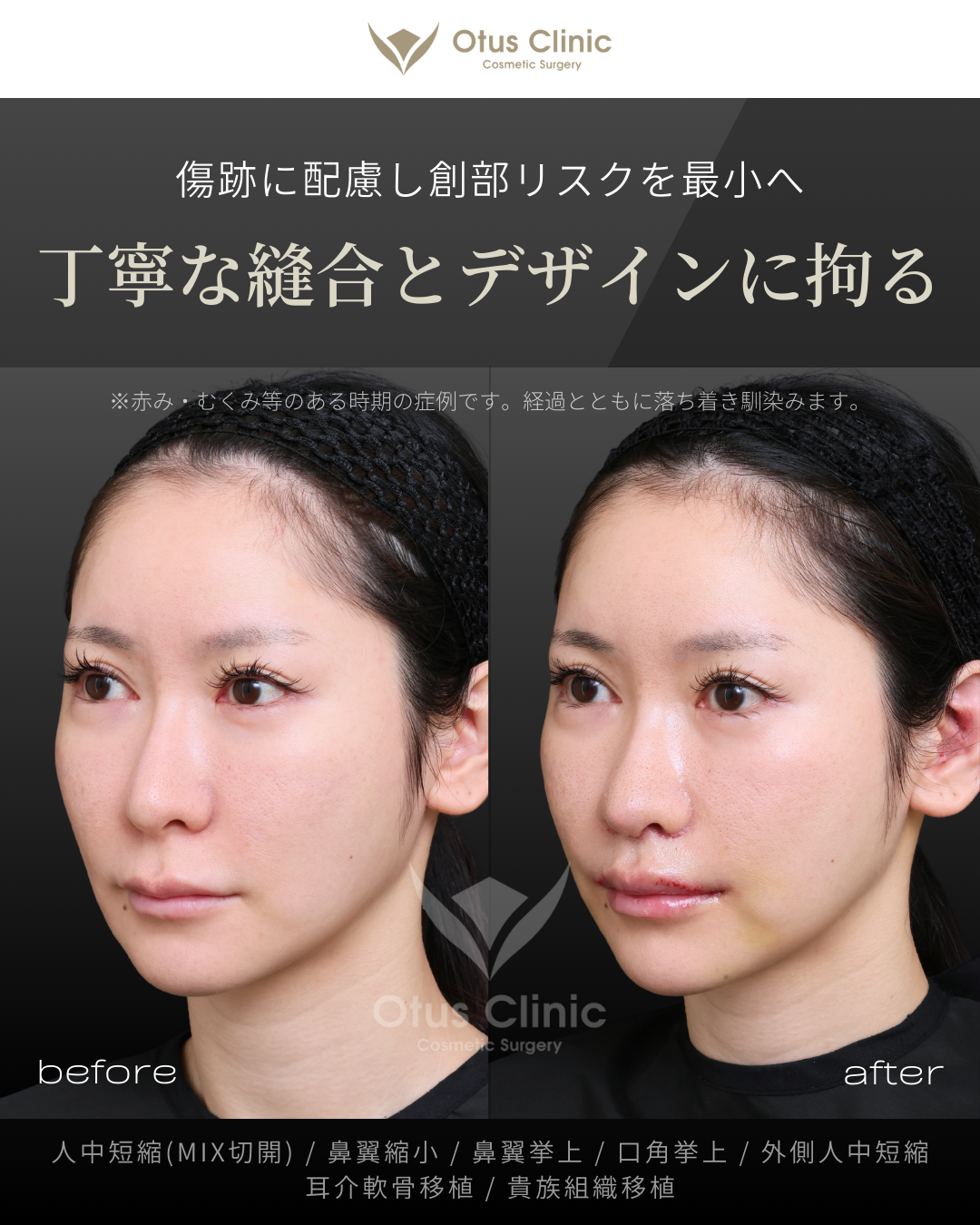 人中短縮(鼻柱切開×鼻孔内切開)・鼻翼縮小・鼻翼挙上・口角挙上・外側人中短縮・貴族組織移植・耳介軟骨移植