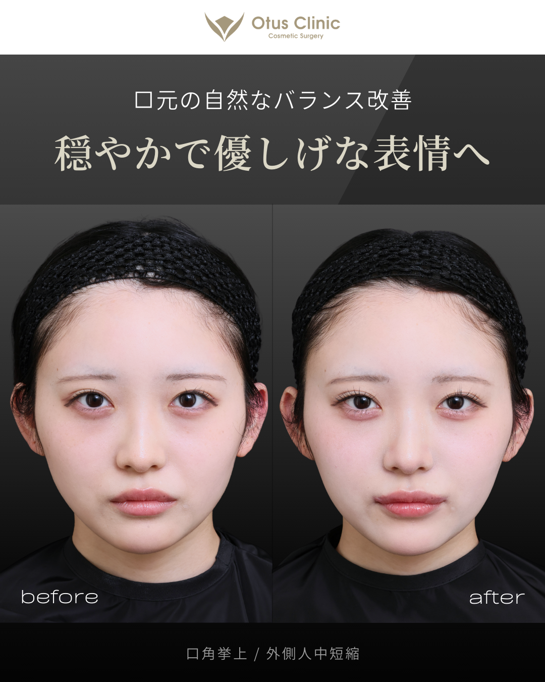 口角挙上・外側人中短縮