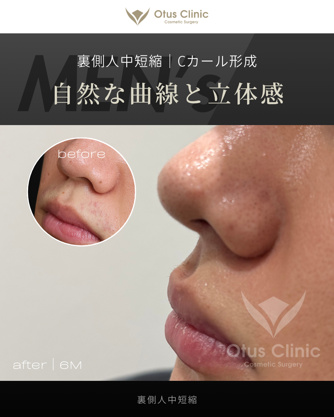 裏側人中短縮（切らない人中短縮）