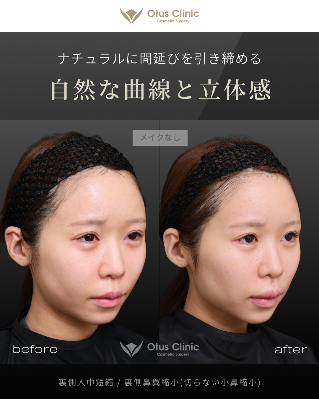 裏側人中短縮（切らない人中短縮）・裏側鼻翼縮小（切らない小鼻縮小）