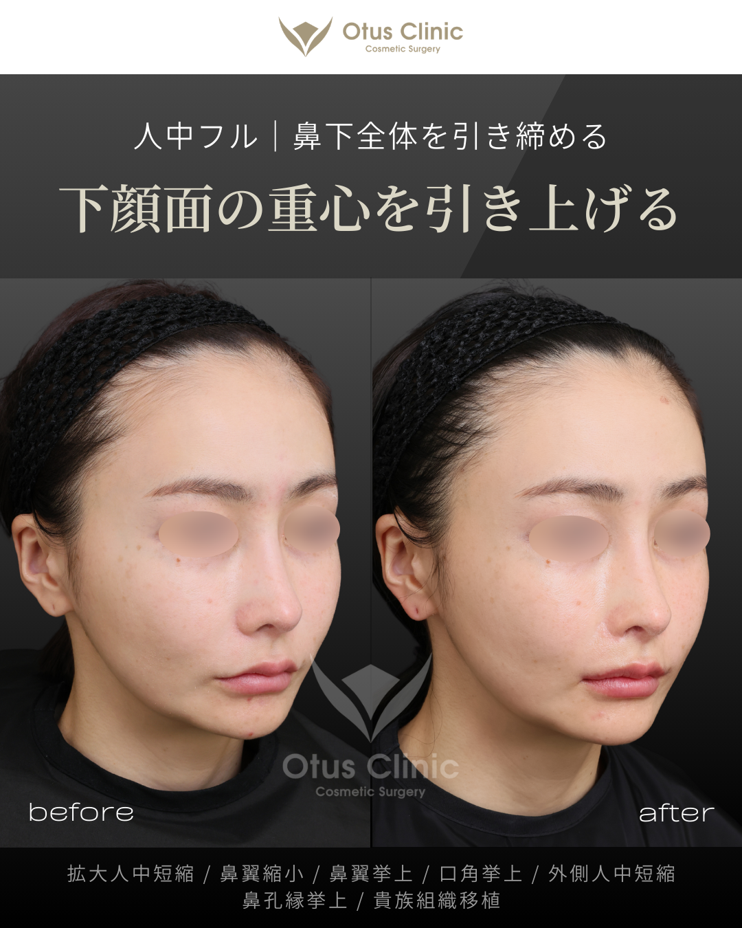 人中フル（人中短縮＋鼻翼縮小＋鼻翼挙上＋口角挙上＋外側人中短縮）・拡大人中短縮・貴族組織移植・鼻孔縁挙上