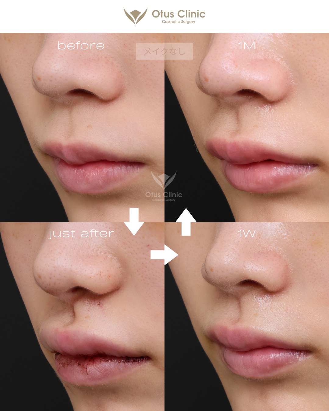 裏側人中短縮（切らない人中短縮）