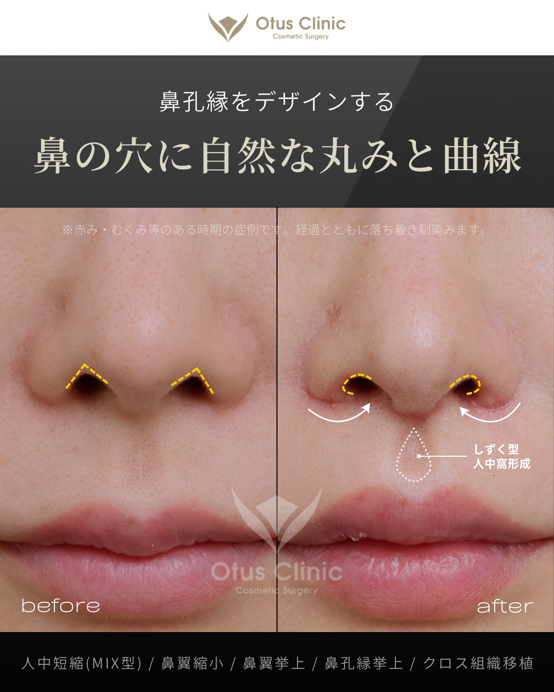 人中短縮(鼻柱切開×鼻腔内切開)・鼻翼縮小・鼻翼挙上・鼻孔縁挙上・クロス組織移植