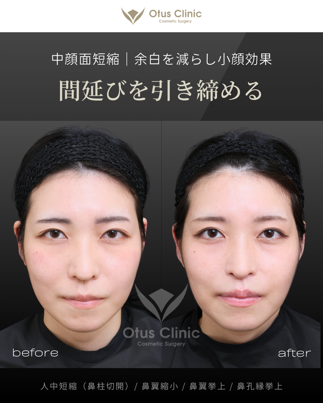 鼻柱切開人中短縮・鼻翼縮小・鼻翼挙上・鼻孔縁挙上