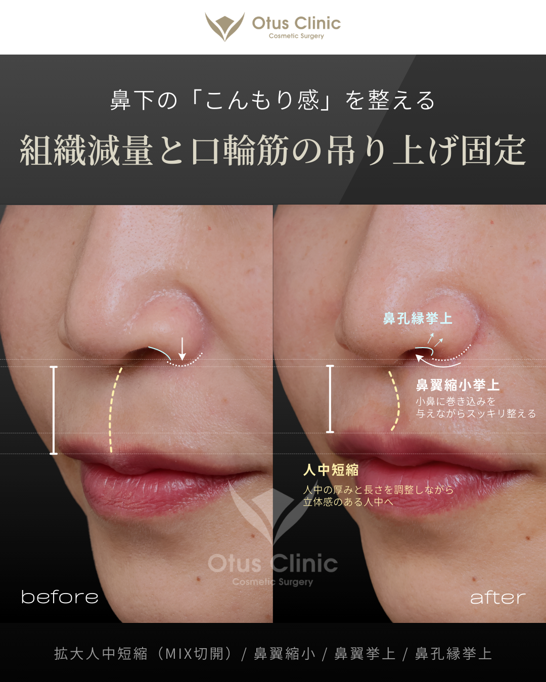 拡大人中短縮（MIX切開）/ 鼻翼縮小 / 鼻翼挙上 / 鼻孔縁挙上
