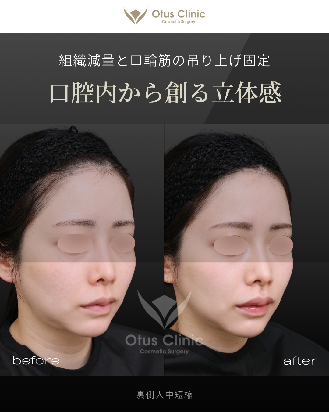 裏側人中短縮（切らない人中短縮）