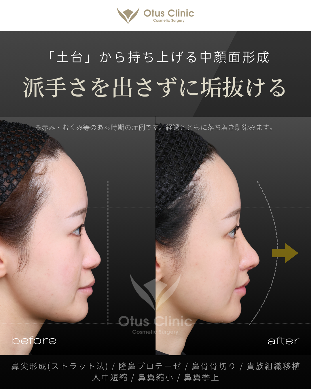 鼻尖形成(耳介軟骨移植つき)・ストラット法・隆鼻プロテーゼ・鼻骨骨切り・貴族組織移植・鼻柱切開人中短縮・鼻翼縮小・鼻翼挙上