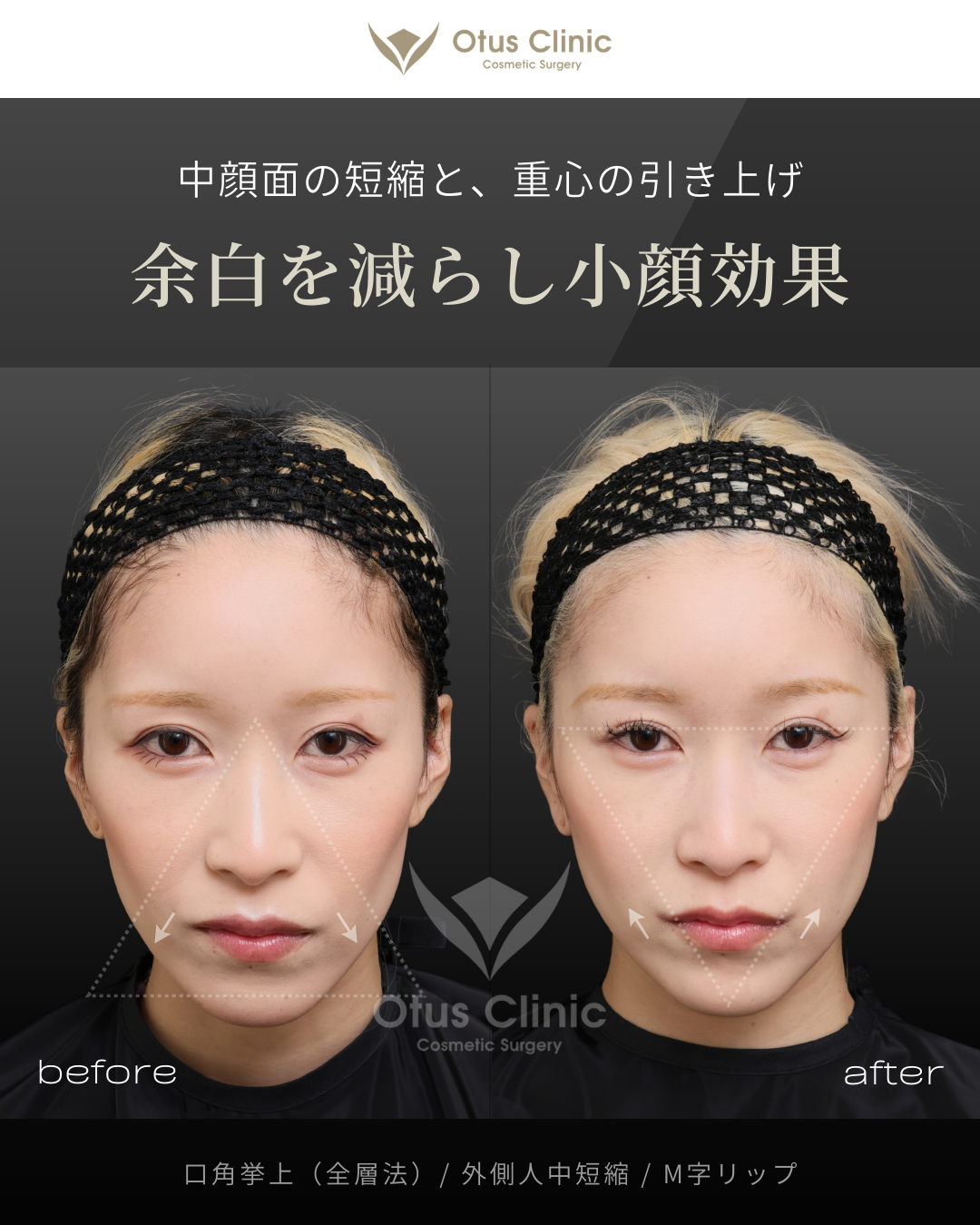口角挙上（全層法）・外側人中短縮・M字リップ