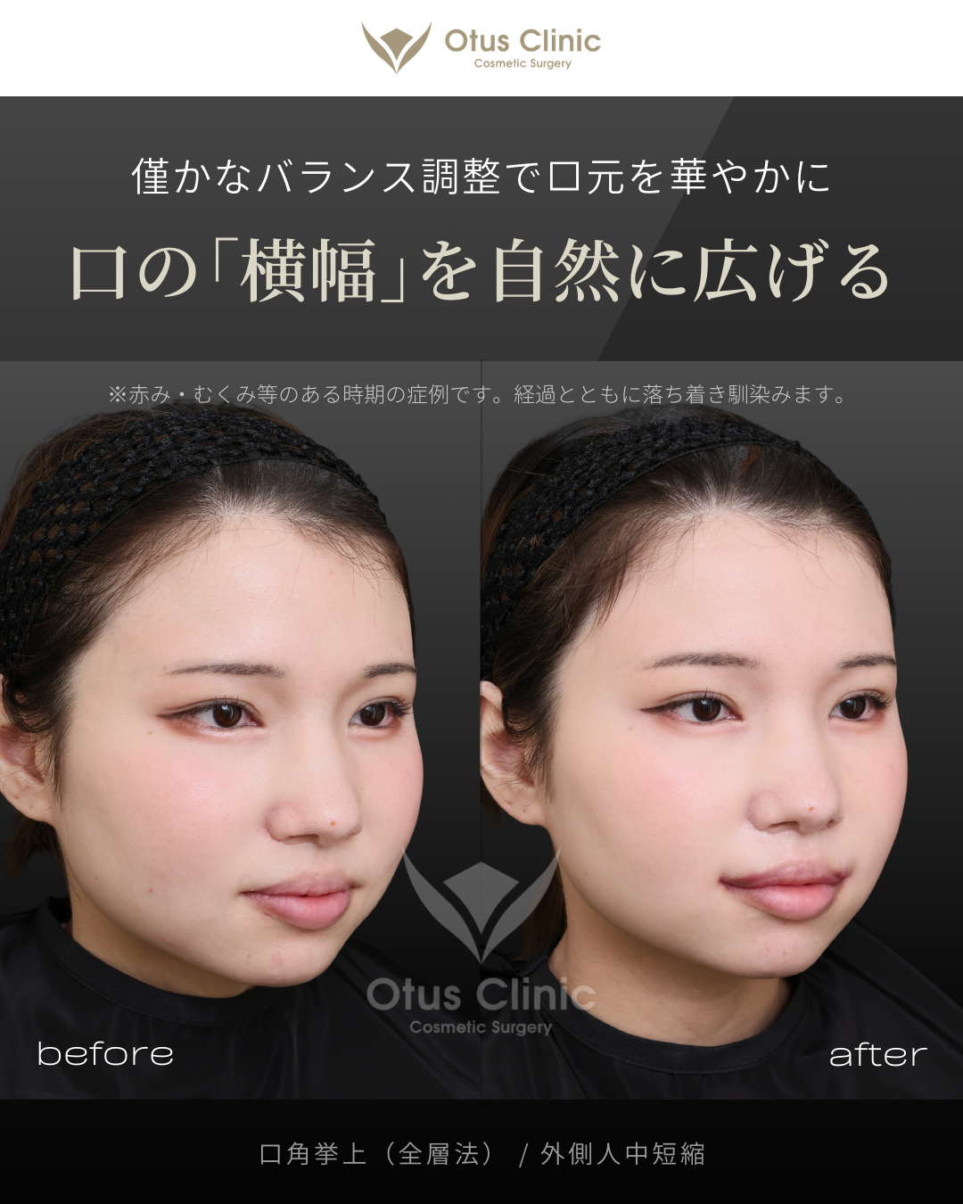 口角挙上（全層法）・外側人中短縮