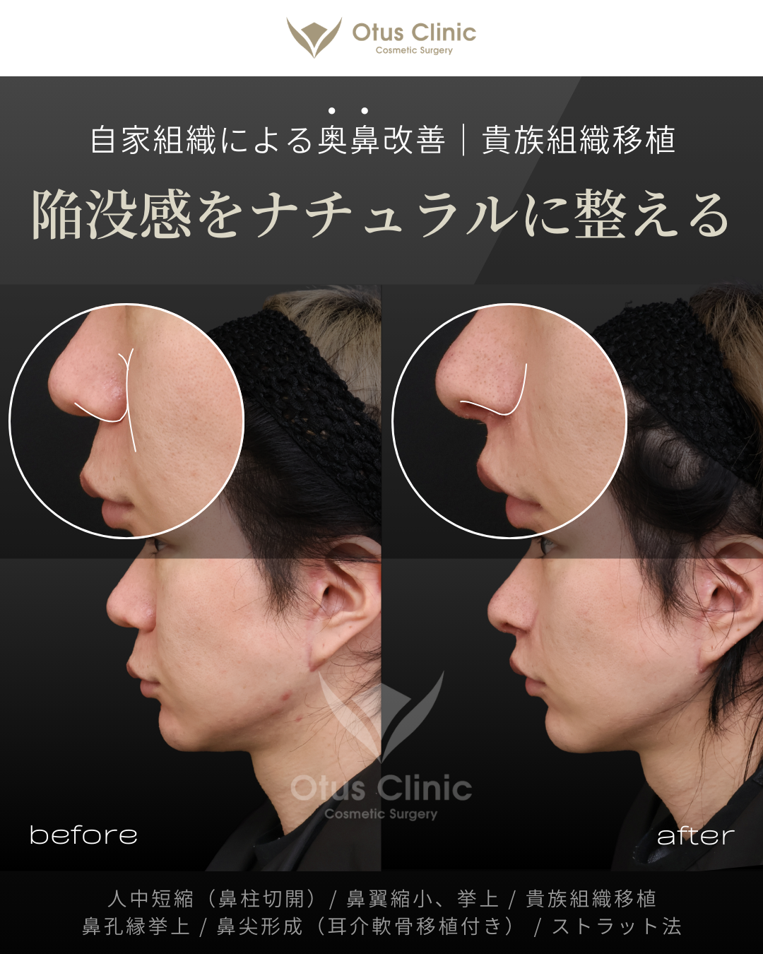 鼻柱切開人中短縮・鼻翼縮小・鼻翼挙上・貴族組織移植・鼻孔縁挙上 ・鼻尖形成（耳介軟骨移植付き）・ストラット法