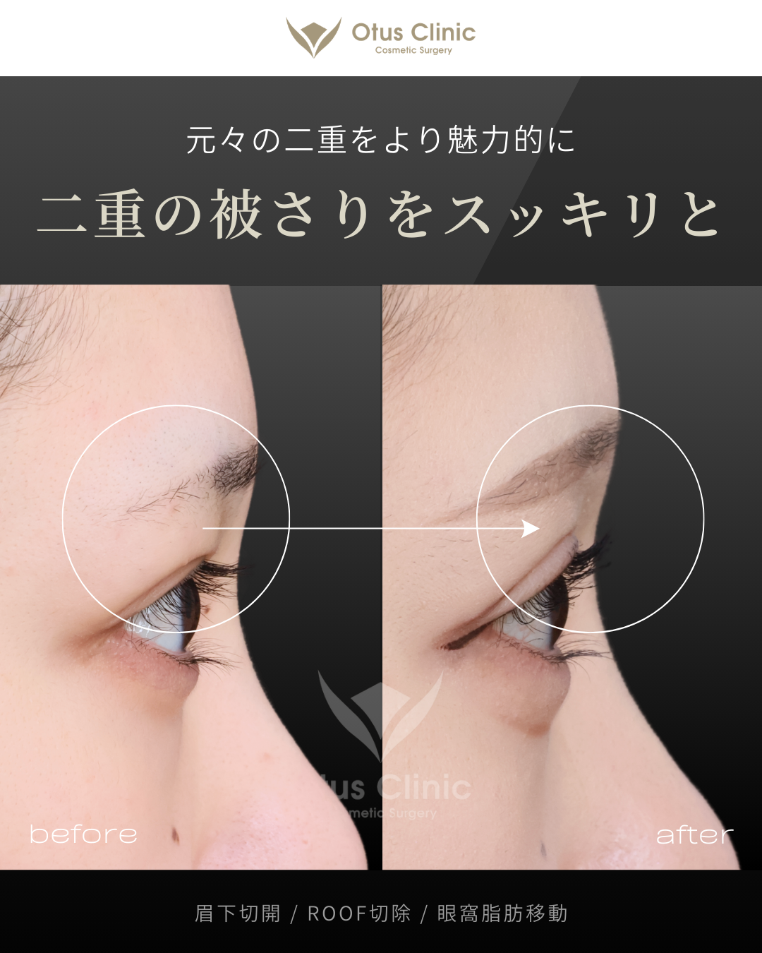 眉下切開・ROOF切除・眼窩脂肪移動