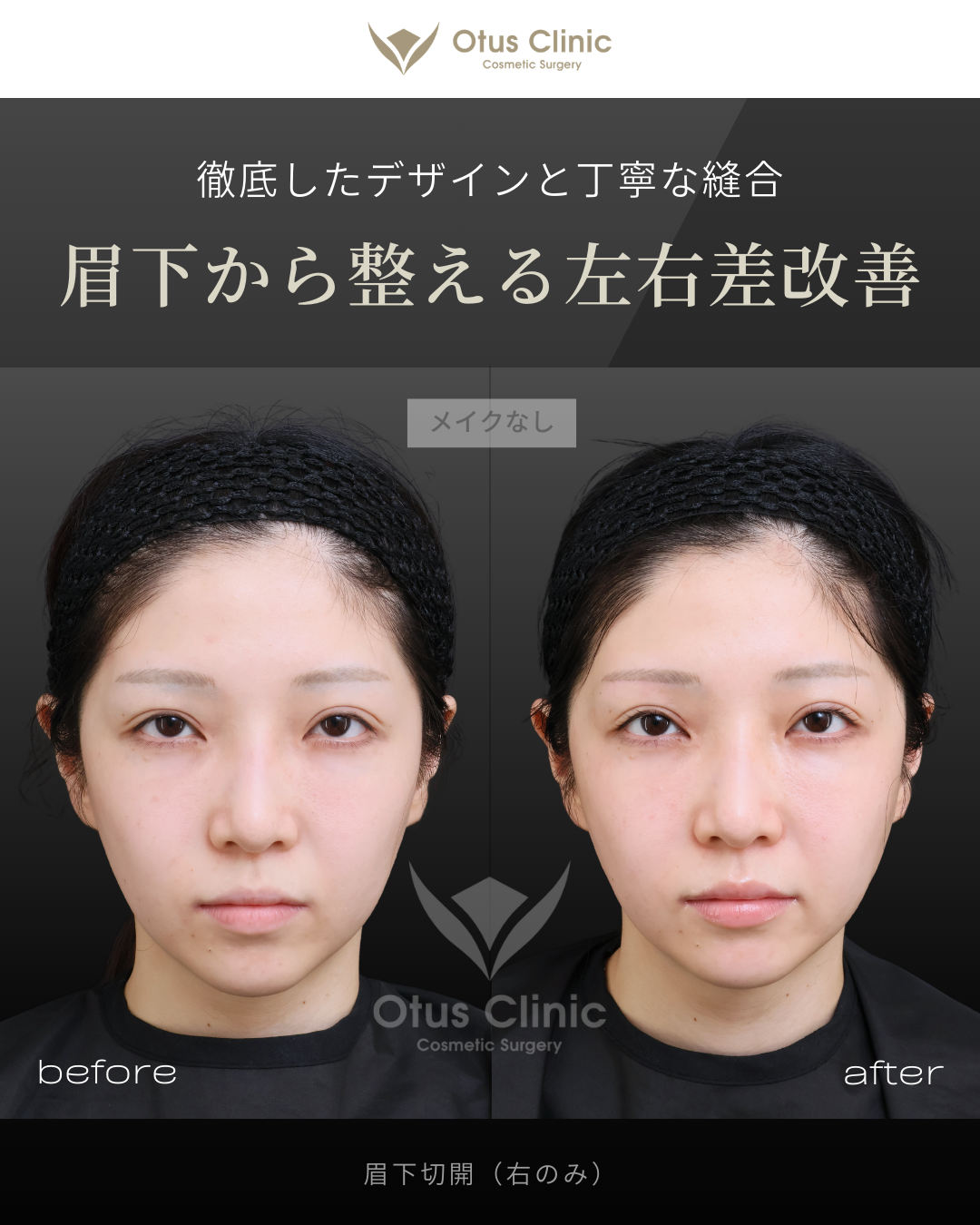 眉下切開（右のみ）