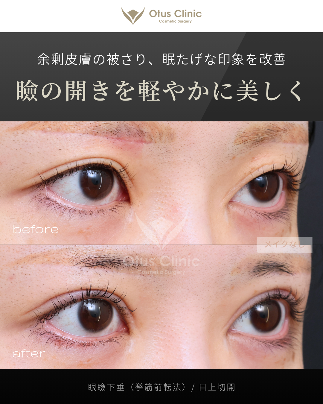 眼瞼下垂（挙筋前転法）・目上切開