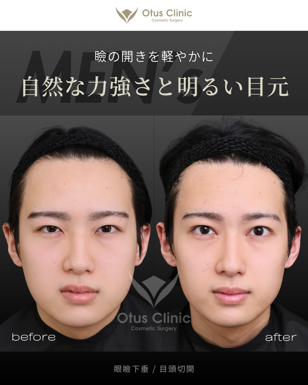 眼瞼下垂・目頭切開