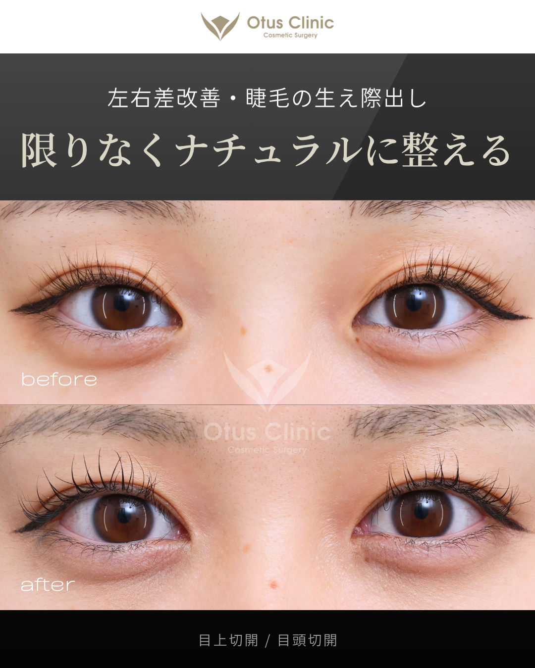 目上切開・目頭切開