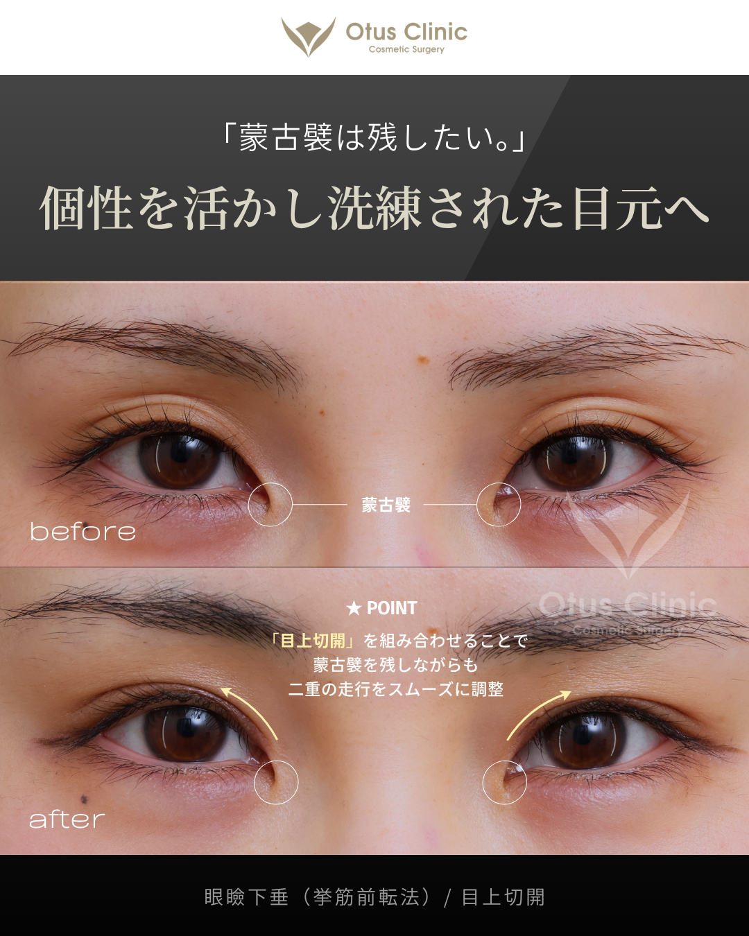 眼瞼下垂（挙筋前転法）・目上切開