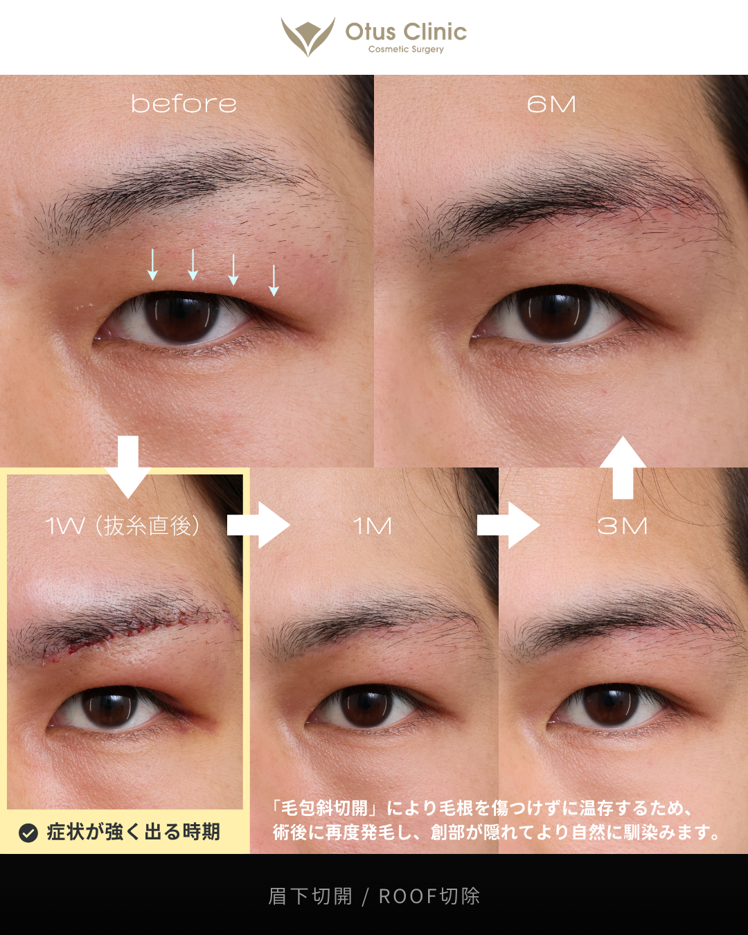 眉下切開・ROOF切除