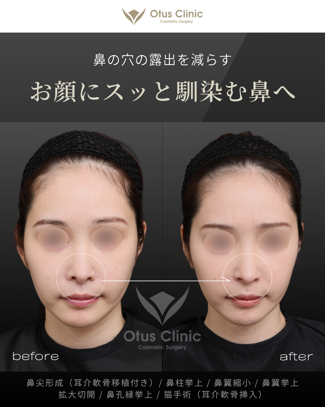 鼻尖形成（耳介軟骨移植付き）・鼻柱挙上・鼻翼縮小・鼻翼挙上・拡大切開・鼻孔縁挙上・猫手術（耳介軟骨挿入）