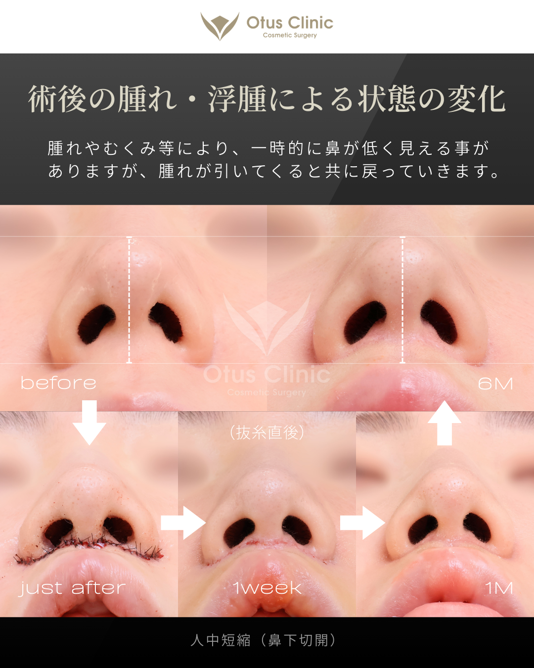 人中短縮（鼻下切開）