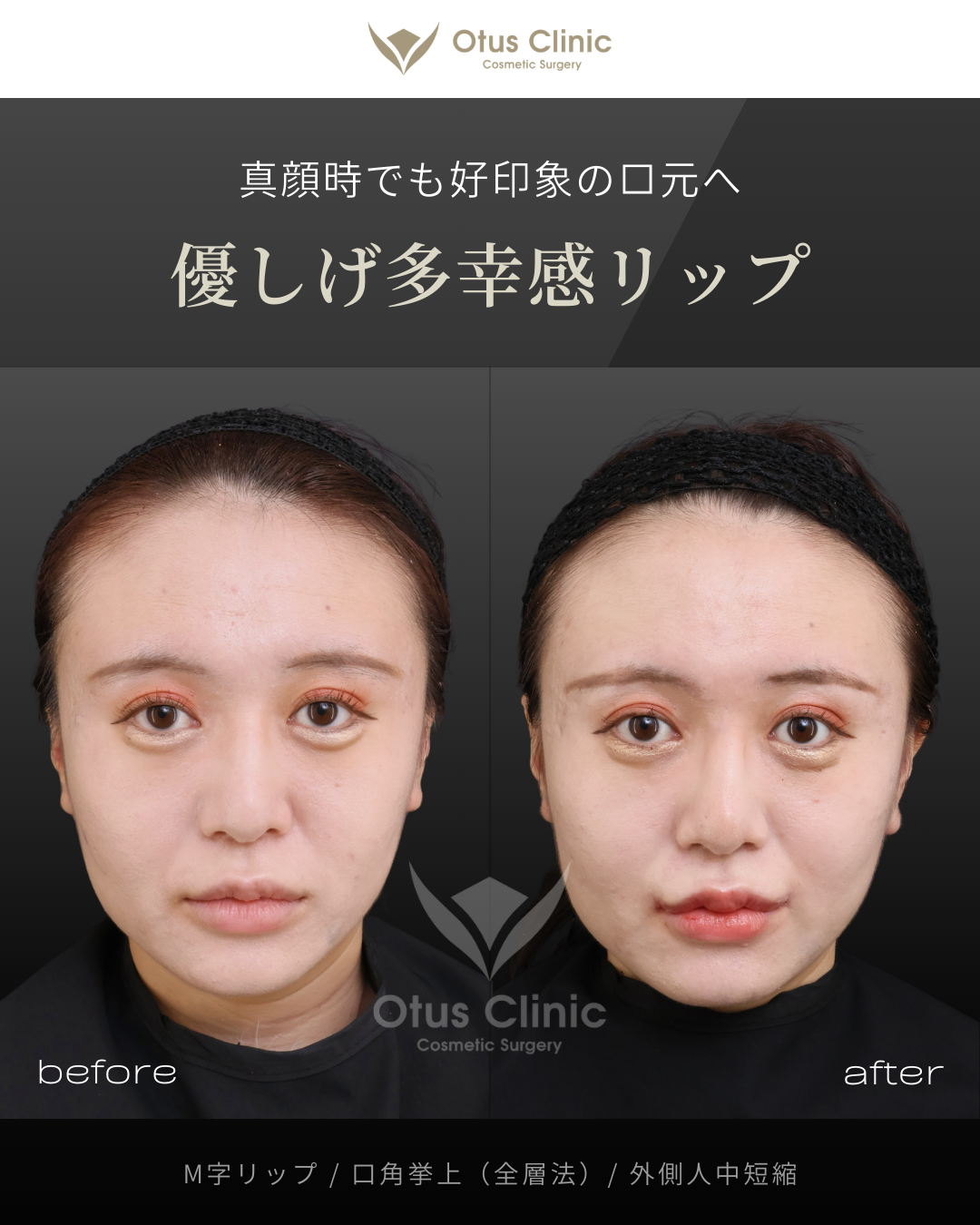 M字リップ・口角挙上 (全層法)・外側人中短縮