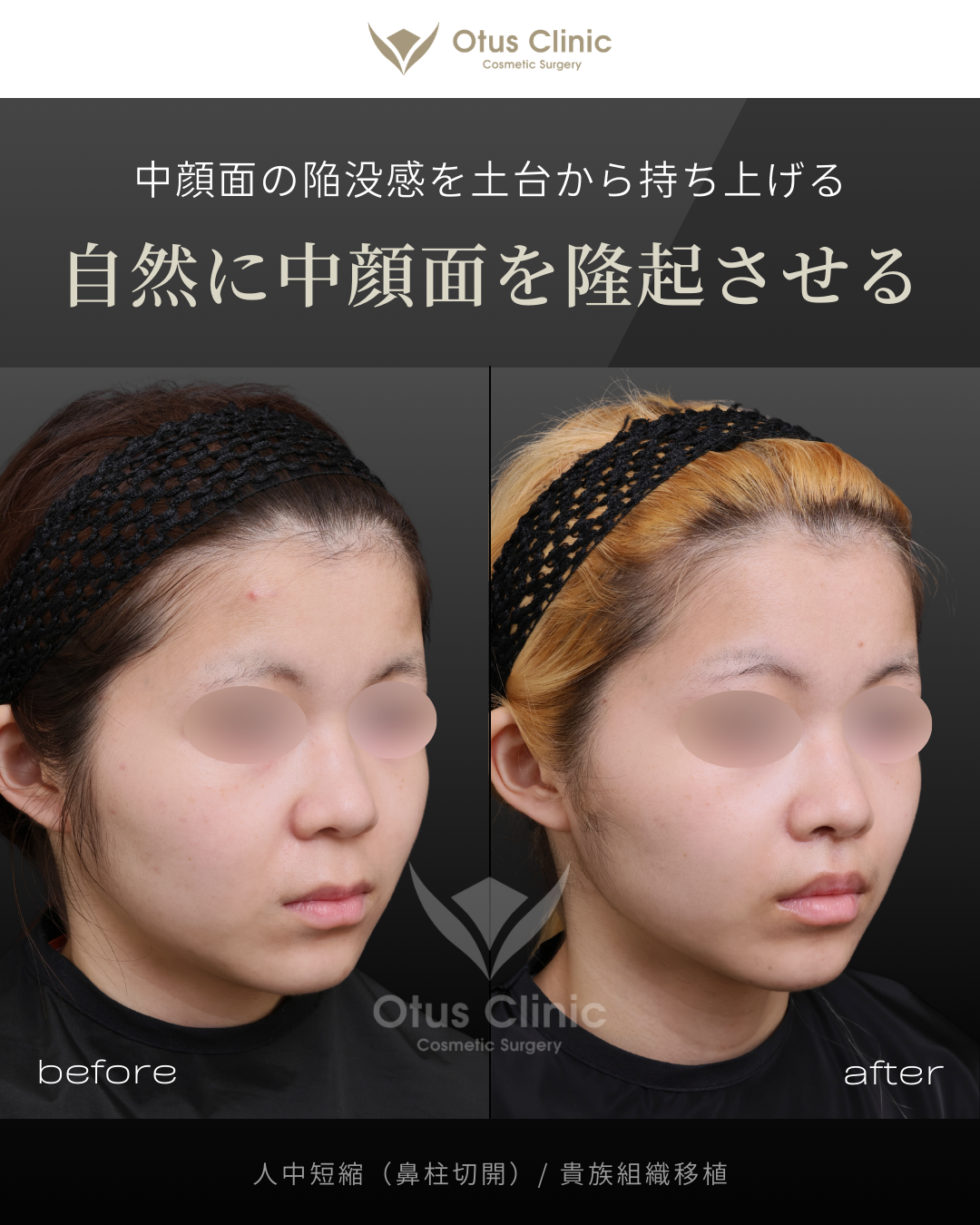 鼻柱切開人中短縮・貴族組織移植
