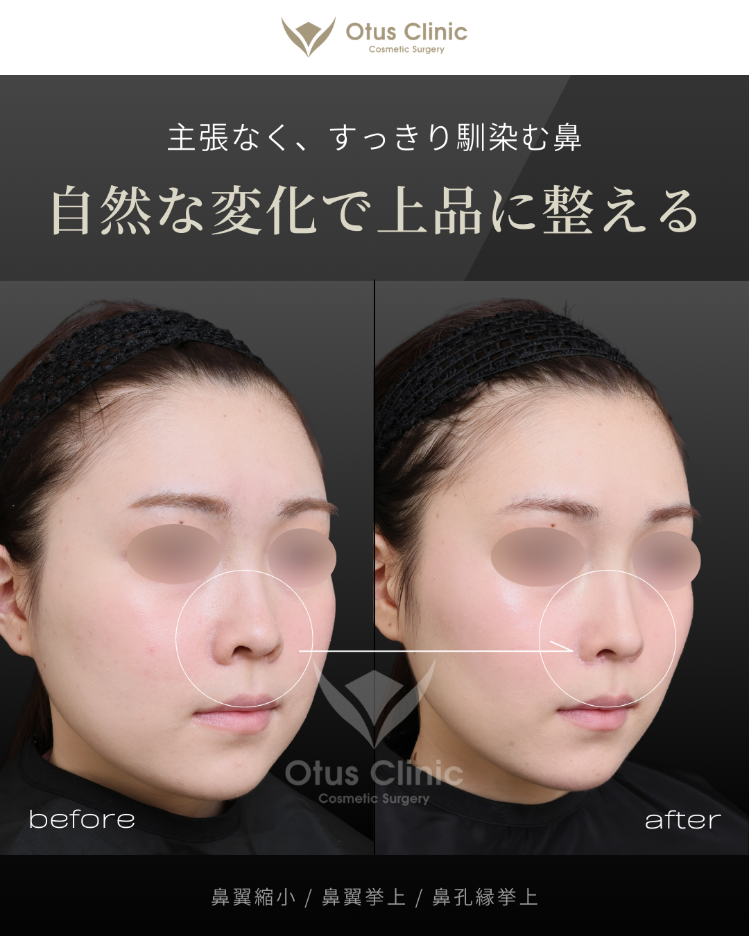 鼻翼縮小・鼻翼挙上・鼻孔縁挙上