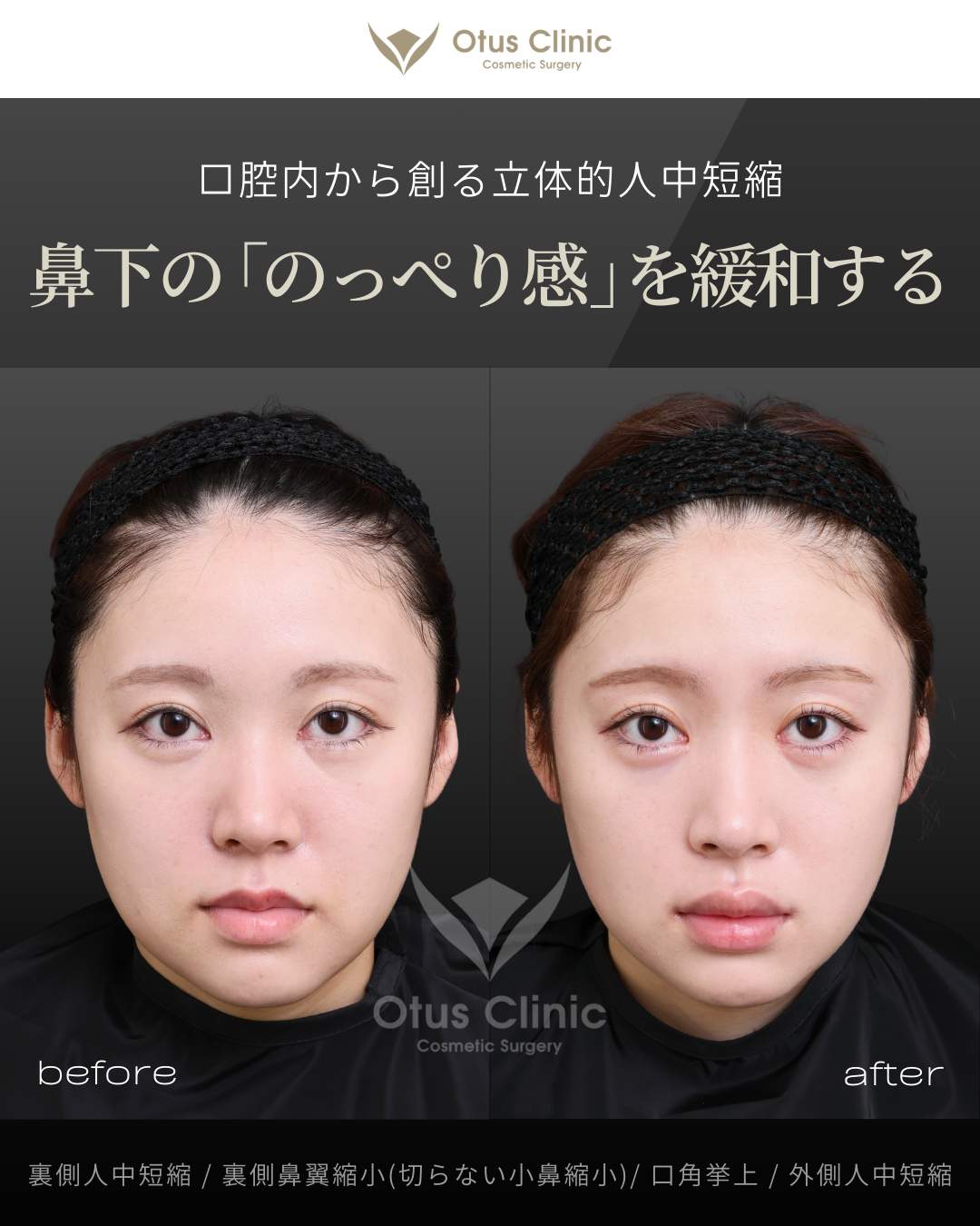 裏側人中短縮・裏側鼻翼縮小(切らない鼻翼縮小)・口角挙上・外側人中短縮