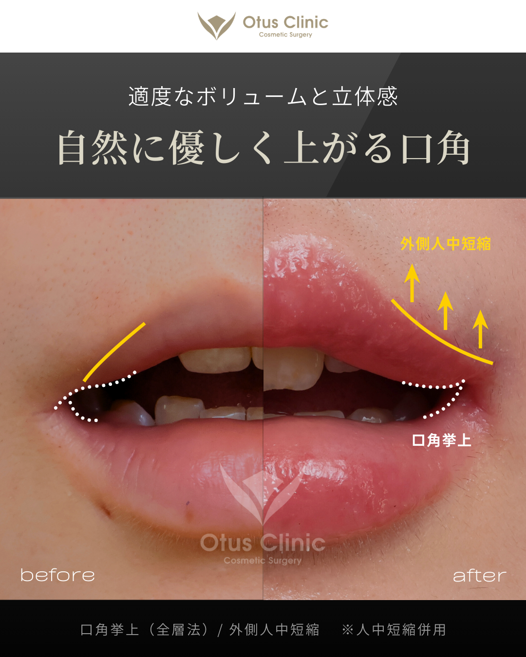 口角挙上・外側人中短縮・人中短縮