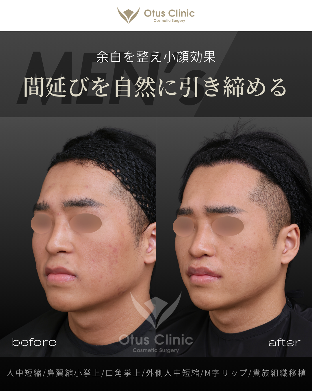 人中フル（人中短縮 / 鼻翼縮小 / 鼻翼挙上 / 外側人中短縮 / 口角挙上）・M字リップ ・貴族組織移植