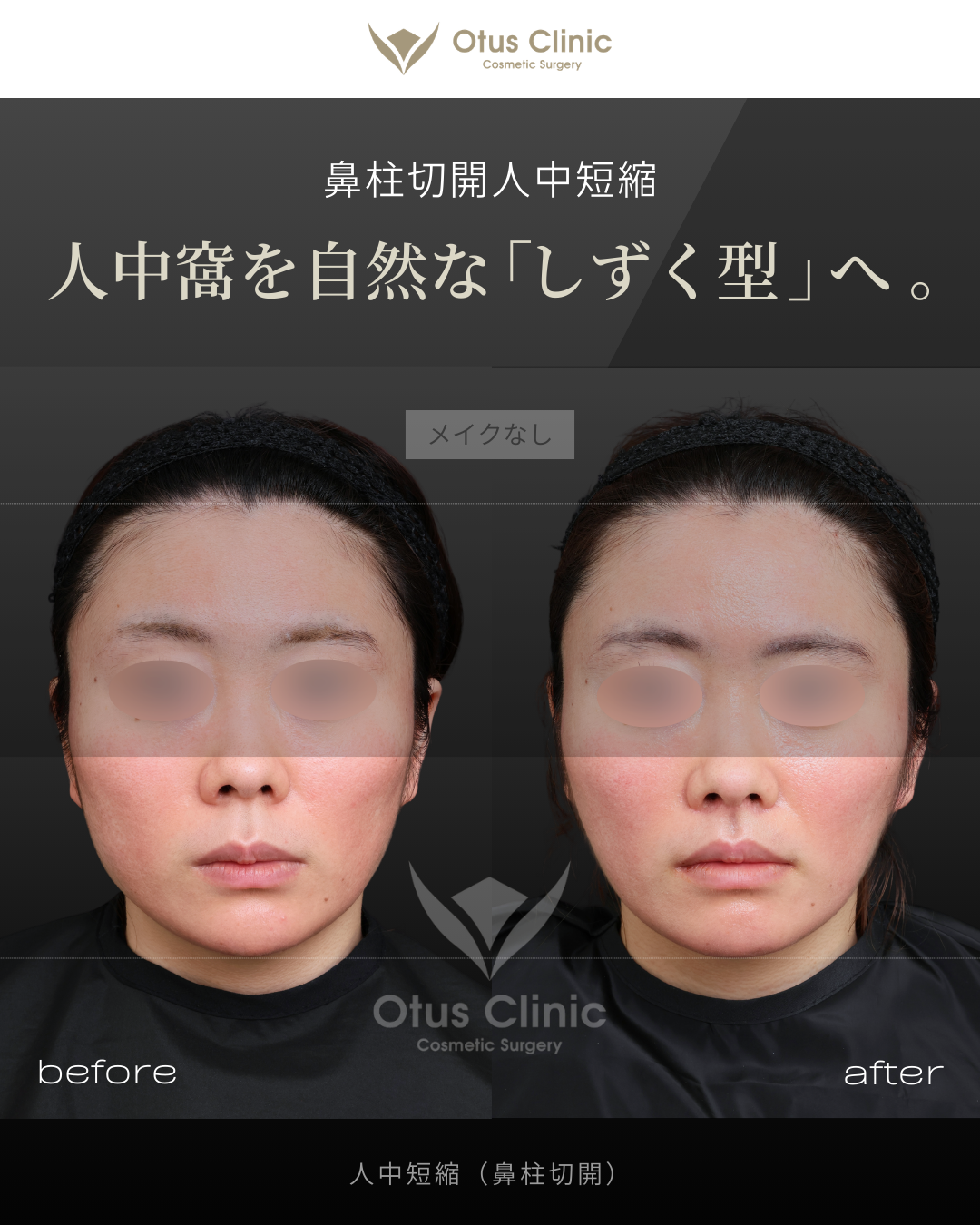 鼻柱切開人中短縮