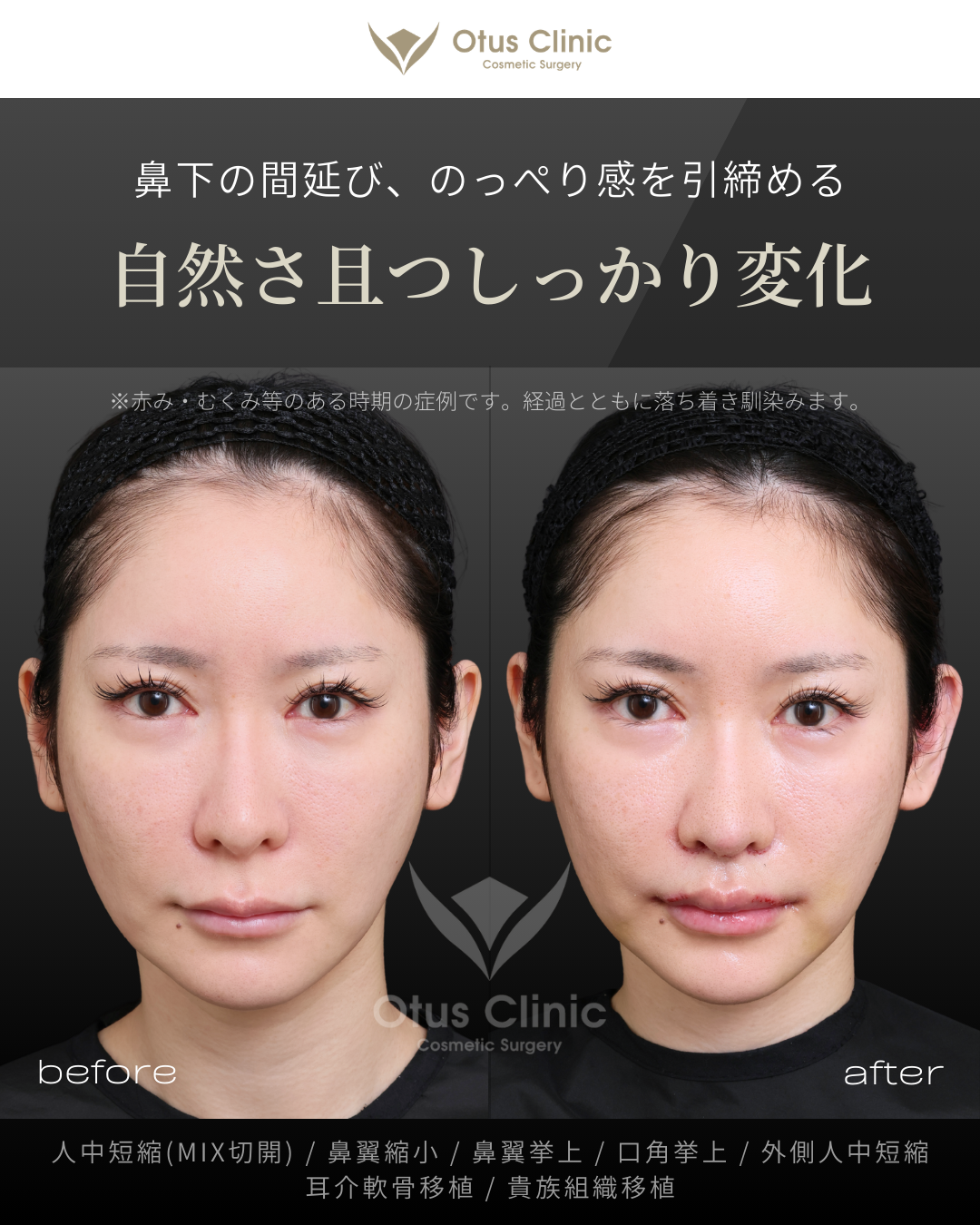 人中短縮(鼻柱切開×鼻孔内切開)・鼻翼縮小・鼻翼挙上・口角挙上・外側人中短縮・貴族組織移植・耳介軟骨移植