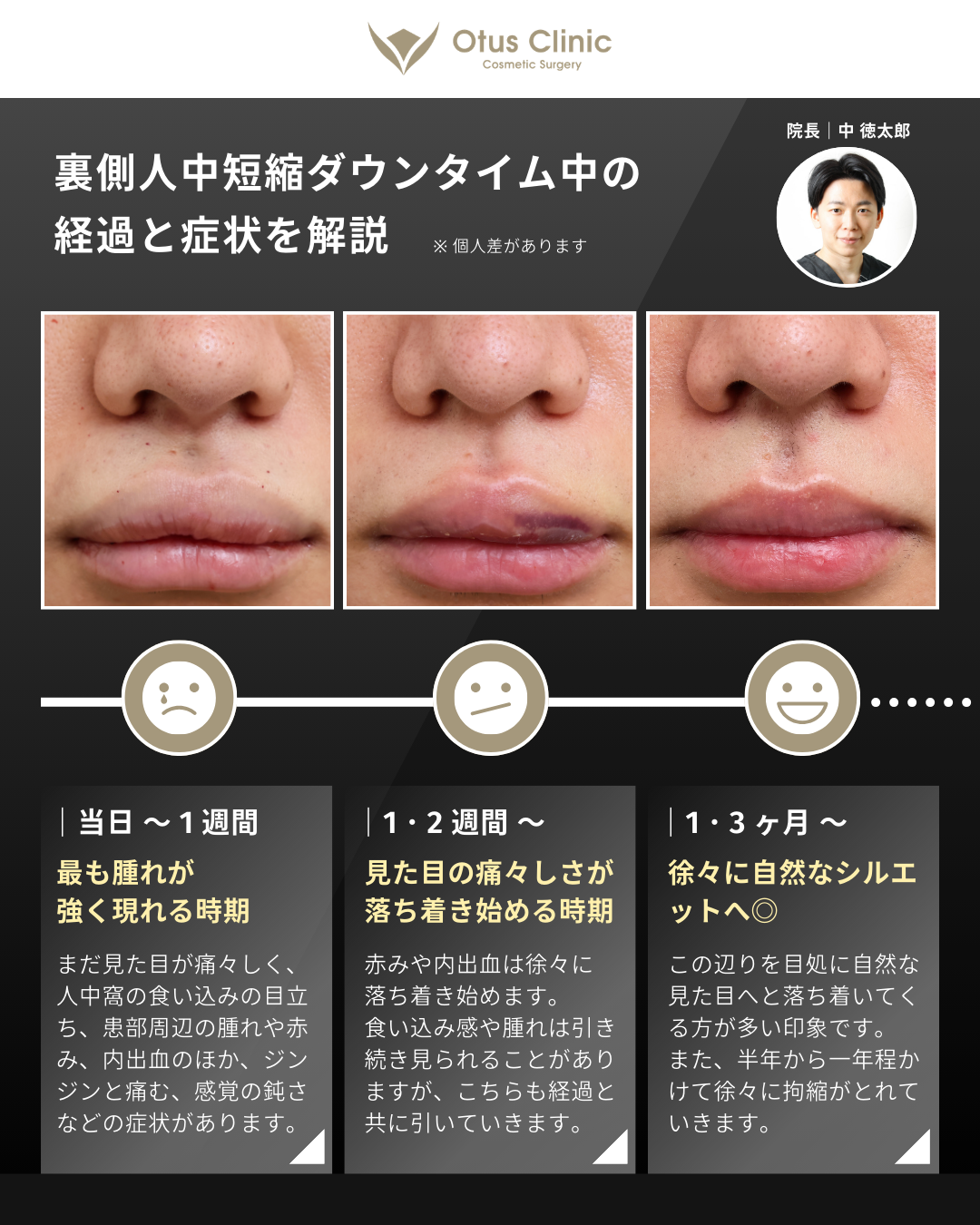 裏側人中短縮（切らない人中短縮）