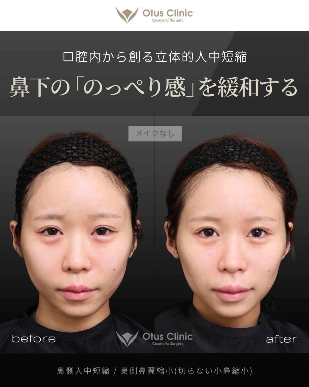 裏側人中短縮（切らない人中短縮）・裏側鼻翼縮小（切らない小鼻縮小）