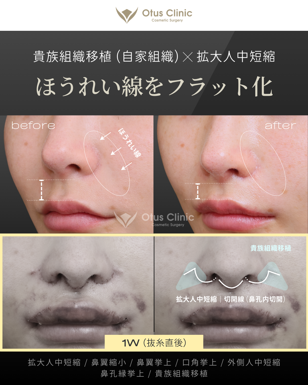 人中フル（人中短縮＋鼻翼縮小＋鼻翼挙上＋口角挙上＋外側人中短縮）・拡大人中短縮・貴族組織移植・鼻孔縁挙上