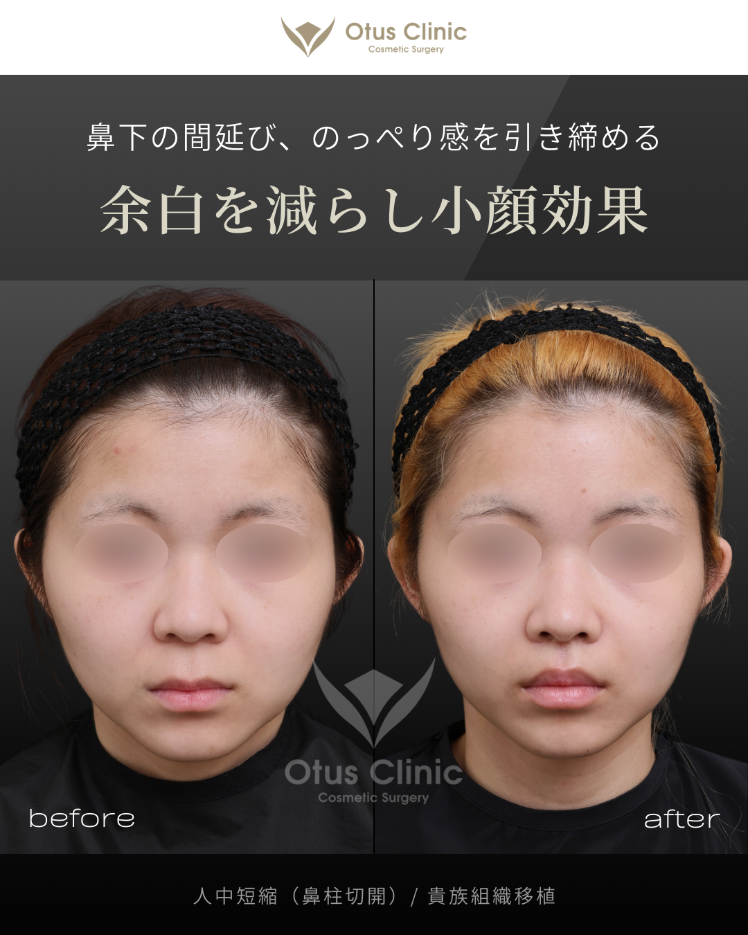 鼻柱切開人中短縮・貴族組織移植