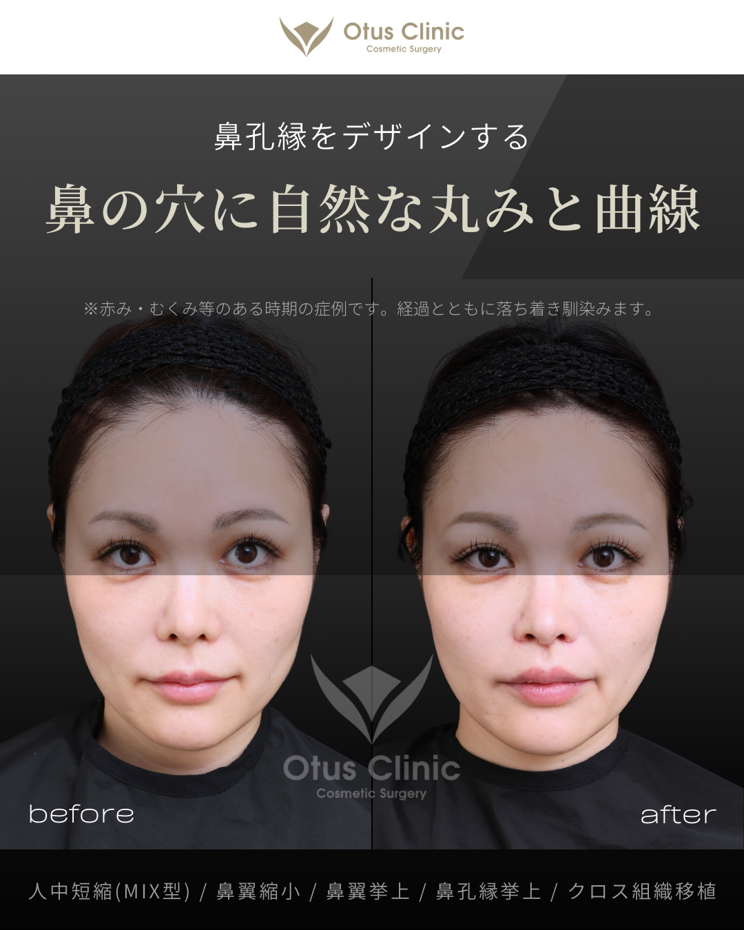 人中短縮(鼻柱切開×鼻腔内切開)・鼻翼縮小・鼻翼挙上・鼻孔縁挙上・クロス組織移植