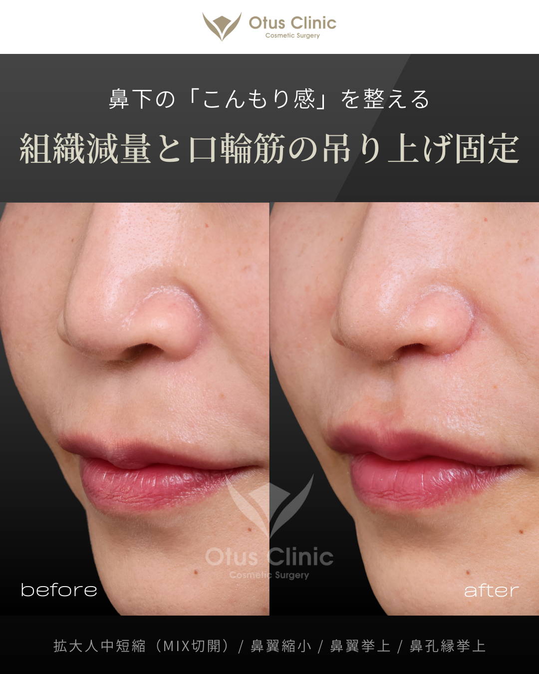 拡大人中短縮（MIX切開）/ 鼻翼縮小 / 鼻翼挙上 / 鼻孔縁挙上