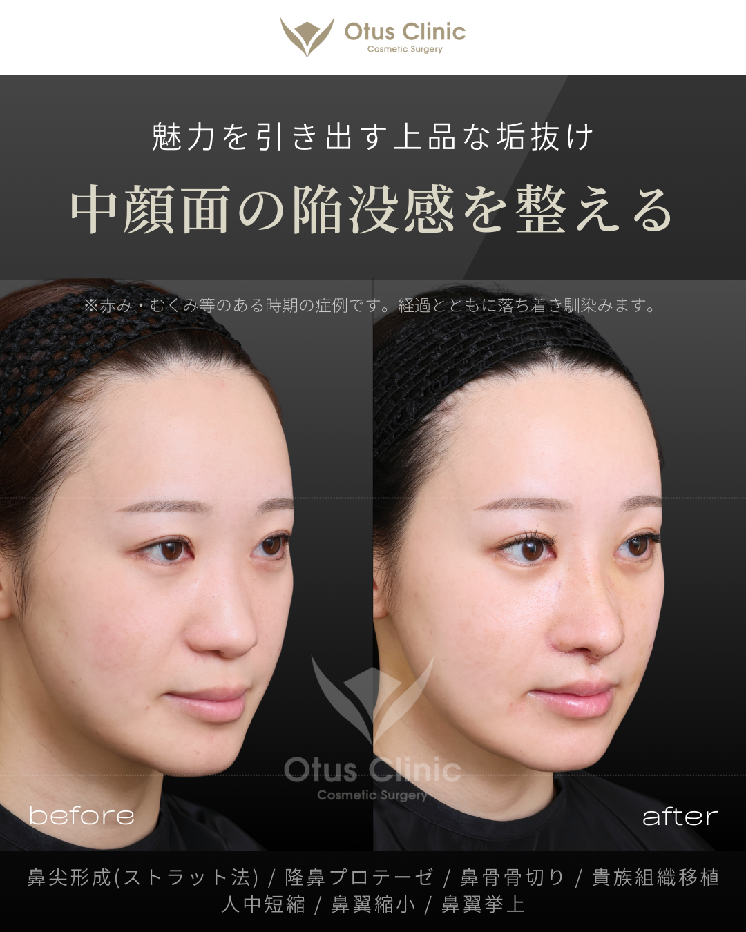 鼻尖形成(耳介軟骨移植つき)・ストラット法・隆鼻プロテーゼ・鼻骨骨切り・貴族組織移植・鼻柱切開人中短縮・鼻翼縮小・鼻翼挙上