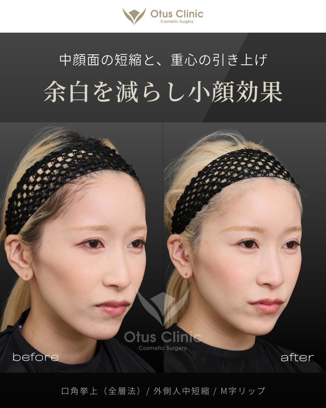 口角挙上（全層法）・外側人中短縮・M字リップ