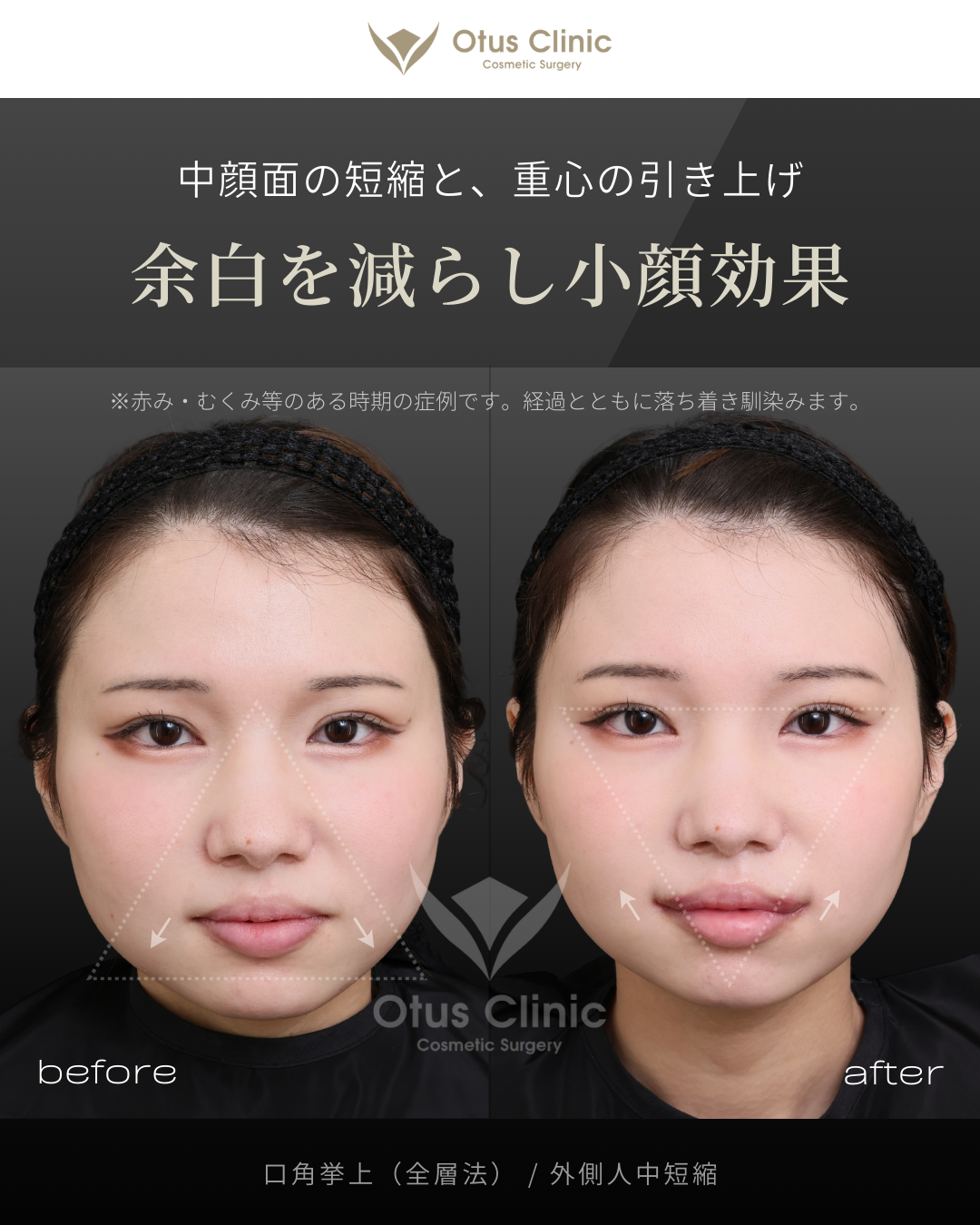 口角挙上（全層法）・外側人中短縮