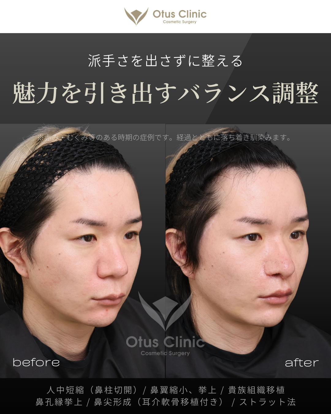 鼻柱切開人中短縮・鼻翼縮小・鼻翼挙上・貴族組織移植・鼻孔縁挙上 ・鼻尖形成（耳介軟骨移植付き）・ストラット法