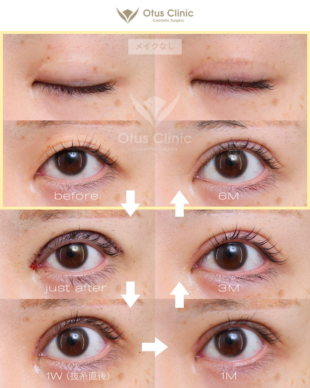 眼瞼下垂（挙筋前転法）・目上切開