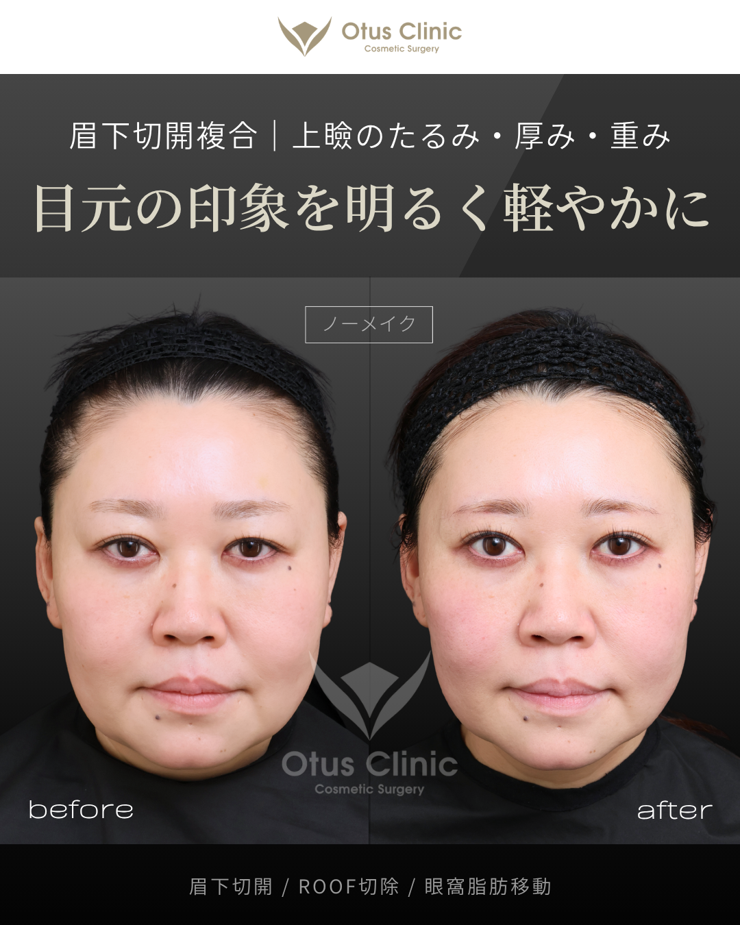 眉下切開・ROOF切除・眼窩脂肪移動