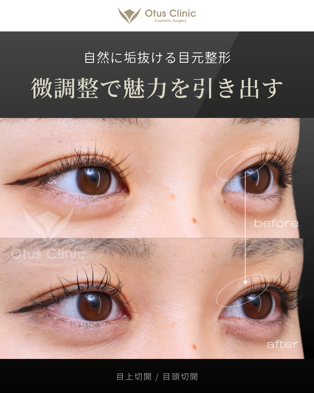 目上切開・目頭切開